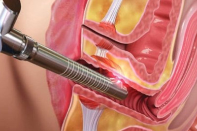 Everything you want to know about Vaginal Tightening Treatment