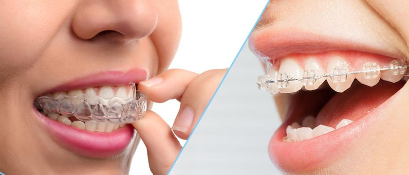 Invisible Braces In Gurgaon - Dental Panache