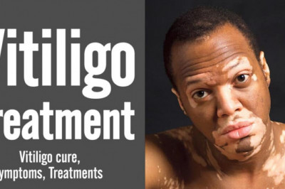 Vitiligo Disease - Ajmal Dawakhana Products