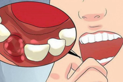 When Bleeding After Dental Surgery Is a Concern